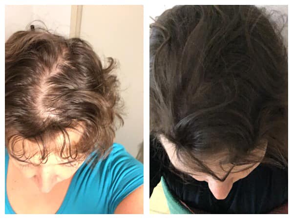 Haarausfall - vorher und nachher