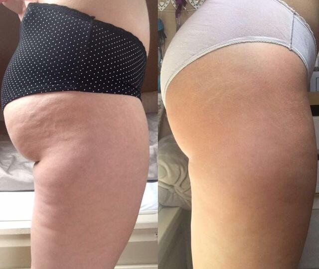 Cellulite